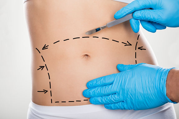 Abdominoplastik Paderborn